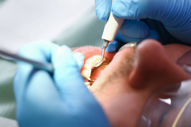 Best Emergency Root Canal Treatment in Winnetka, IL